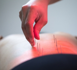 דיקור סיני לחולי סרטן: לעבור את הכימותרפיה ללא תופעות לוואי -תמונה